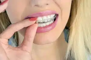 Lady Inserting Mouth Guard